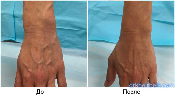 Фото до и после лечения варикоза рук пенной склеротерапией