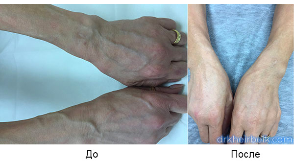 Фото до и после лечения варикоза рук пенной склеротерапией