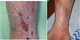 Trophic ulcers