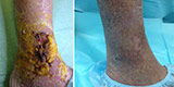 Trophic ulcers