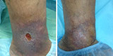 Trophic ulcers