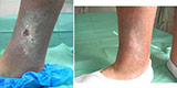 Trophic ulcers