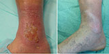 Trophic ulcers