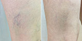 Varicose veins of the lower extremities (Part 2)