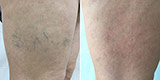 Varicose veins of the lower extremities (Part 2)