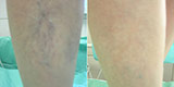Varicose veins of the lower extremities (Part 2)