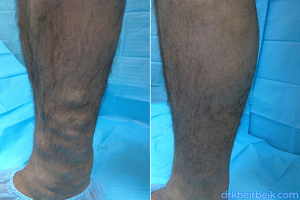 Varicose veins of the lower extremities (Part 2)