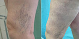 Varicose veins of the lower extremities (Part 2)