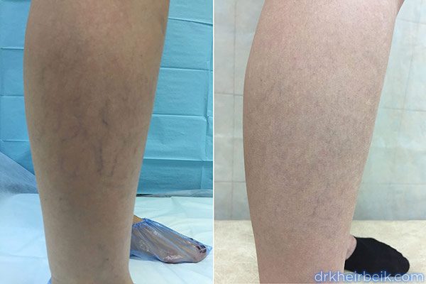 Varicose veins of the lower extremities (Part 2)
