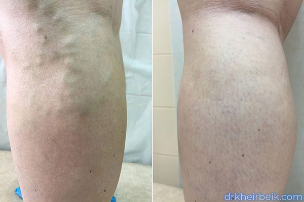 Varicose veins of the lower extremities (Part 2)