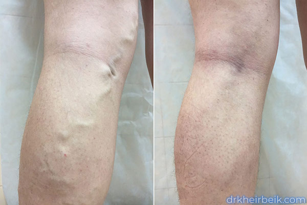 Varicose veins of the lower extremities (Part 2)