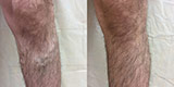 Varicose veins of the lower extremities (Part 1)