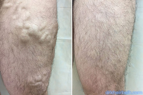 Varicose veins of the lower extremities (Part 1)