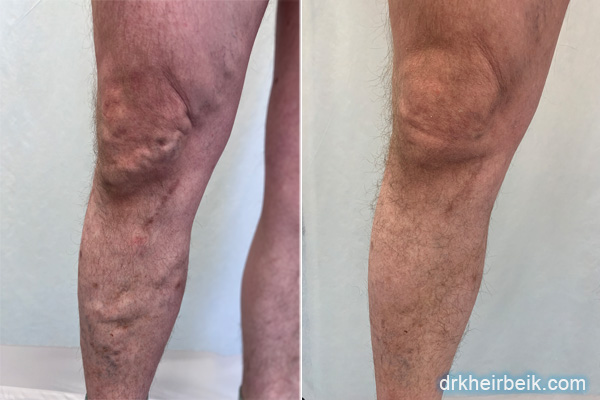 Varicose veins of the lower extremities (Part 4)