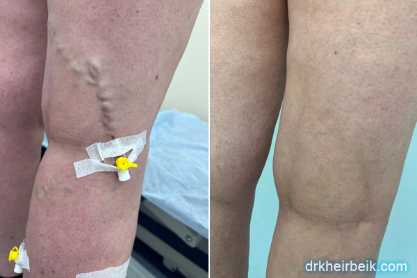 Varicose veins of the lower extremities (Part 4)
