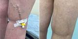 Varicose veins of the lower extremities (Part 4)