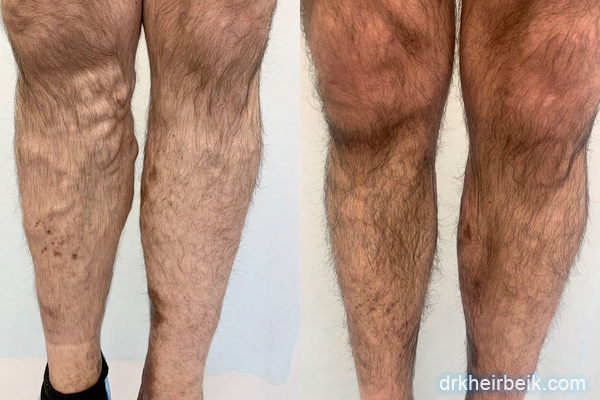 Varicose veins of the lower extremities (Part 4)