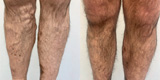 Varicose veins of the lower extremities (Part 4)