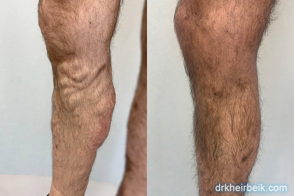 Varicose veins of the lower extremities (Part 4)