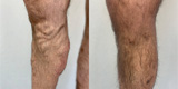 Varicose veins of the lower extremities (Part 4)
