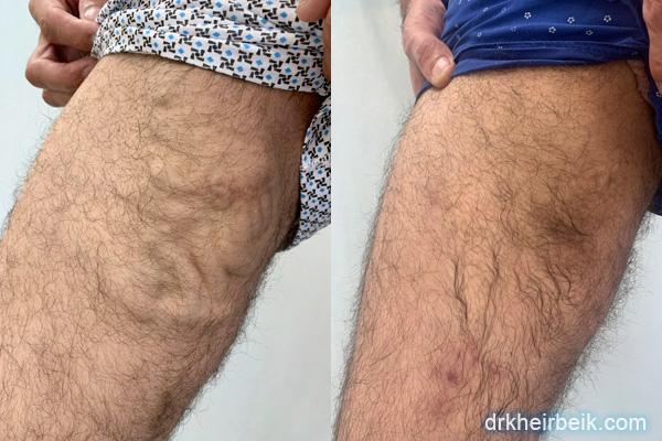 Varicose veins of the lower extremities (Part 4)
