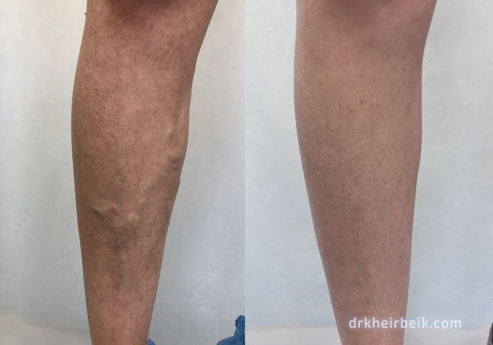 Varicose veins of the lower extremities (Part 3)