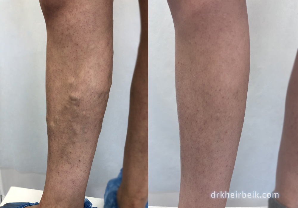Varicose veins of the lower extremities (Part 3)