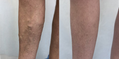 Varicose veins of the lower extremities (Part 3)