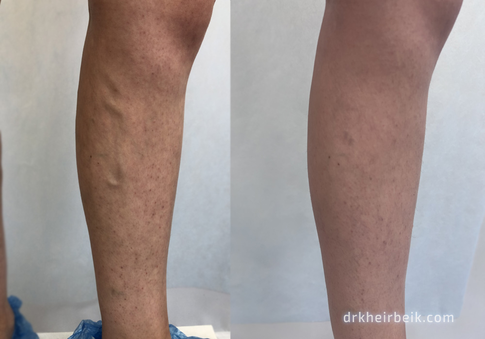 Varicose veins of the lower extremities (Part 3)