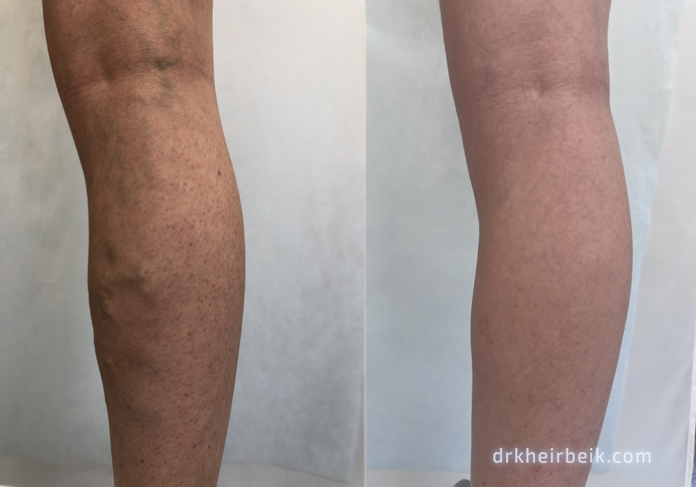 Varicose veins of the lower extremities (Part 3)