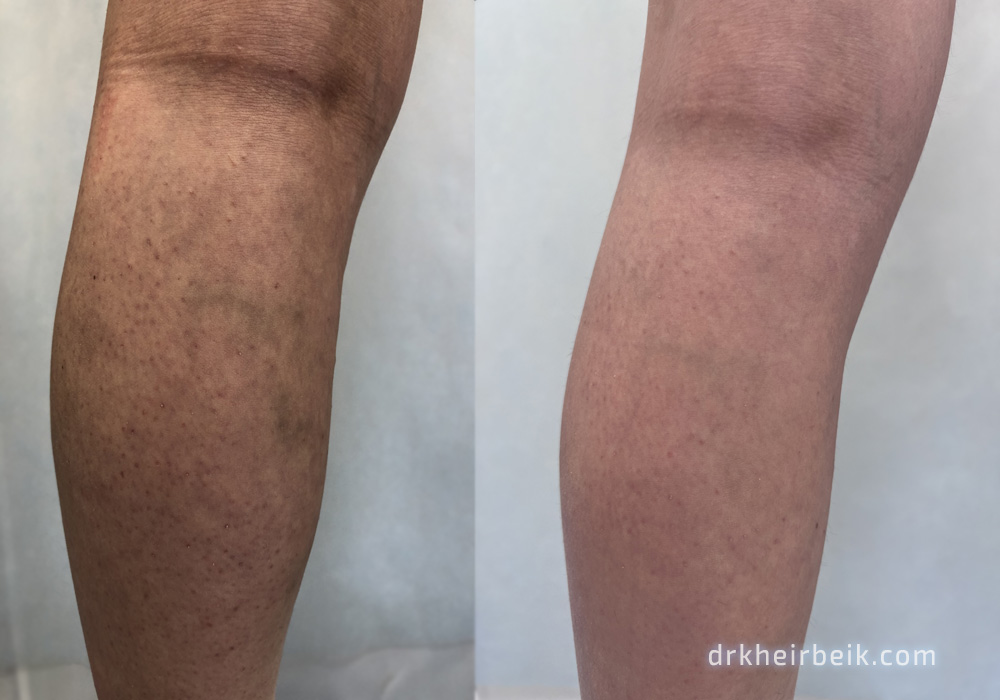 Varicose veins of the lower extremities (Part 3)