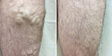 Varicose veins of the lower extremities (Part 1)