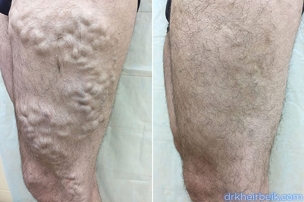 Varicose veins of the lower extremities (Part 1)