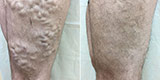 Varicose veins of the lower extremities (Part 1)