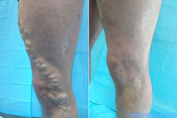 Varicose veins of the lower extremities (Part 1)