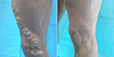 Varicose veins of the lower extremities (Part 1)