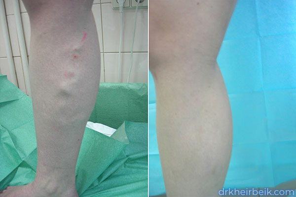 Varicose veins of the lower extremities (Part 1)