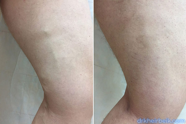 Varicose veins of the lower extremities (Part 1)