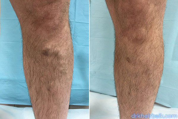 Varicose veins of the lower extremities (Part 1)