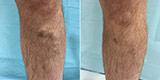Varicose veins of the lower extremities (Part 1)