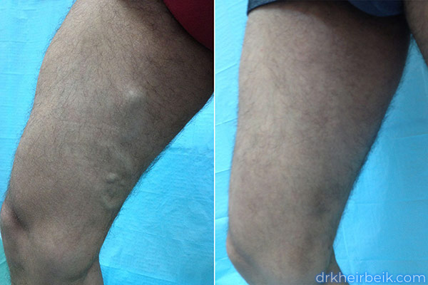 Varicose veins of the lower extremities (Part 1)