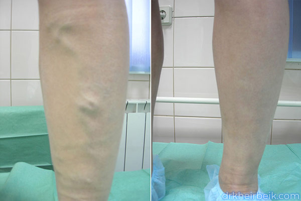 Varicose veins of the lower extremities (Part 1)