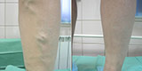 Varicose veins of the lower extremities (Part 1)