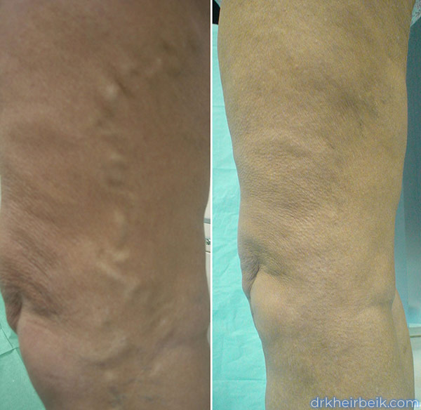 Varicose veins of the lower extremities (Part 1)