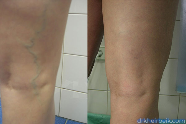 Varicose veins of the lower extremities (Part 1)