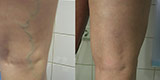 Varicose veins of the lower extremities (Part 1)