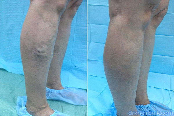 Varicose veins of the lower extremities (Part 1)