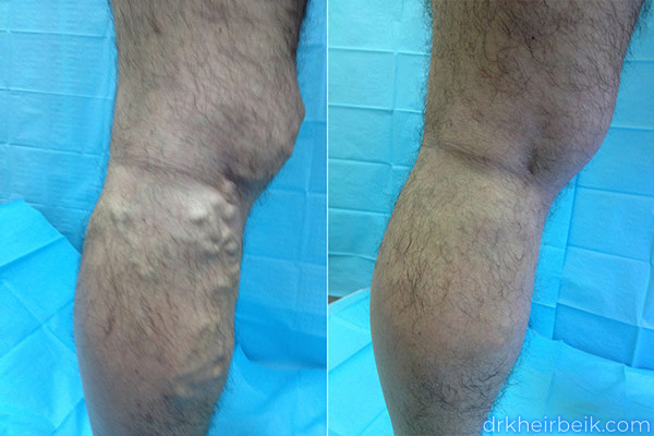 Varicose veins of the lower extremities (Part 1)