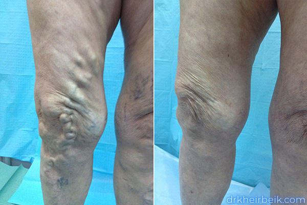 Varicose veins of the lower extremities (Part 1)