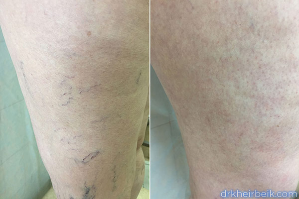 Varicose veins of the lower extremities (Part 1)